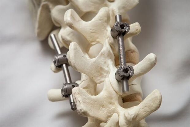 Fixarea osteocondrozei coloanei vertebrale a gâtului