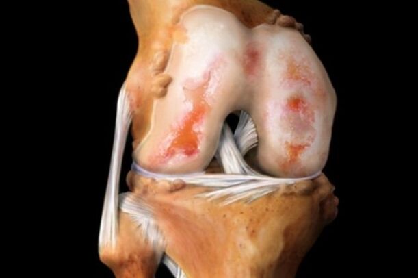 Afectarea cartilajului în osteoartrita genunchiului