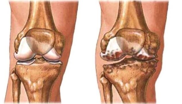 genunchi sănătos și osteoartrita genunchiului
