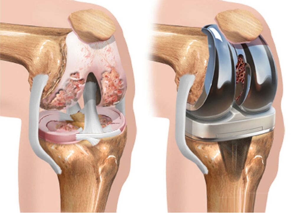 înainte și după osteoartrita articulației genunchiului în osteoartrita