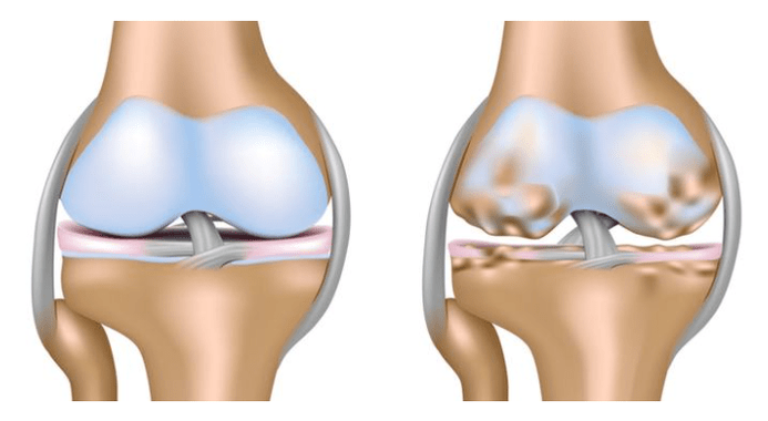 cartilaj sănătos și afectarea articulației genunchiului în osteoartrita