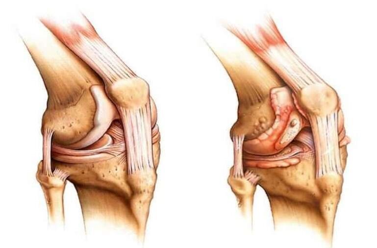 genunchi sănătos și osteoartrita articulației genunchiului