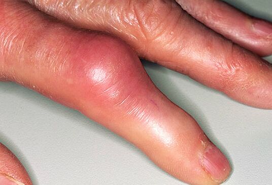 Guta este însoțită de dureri severe la nivelul degetelor și umflarea articulațiilor. 