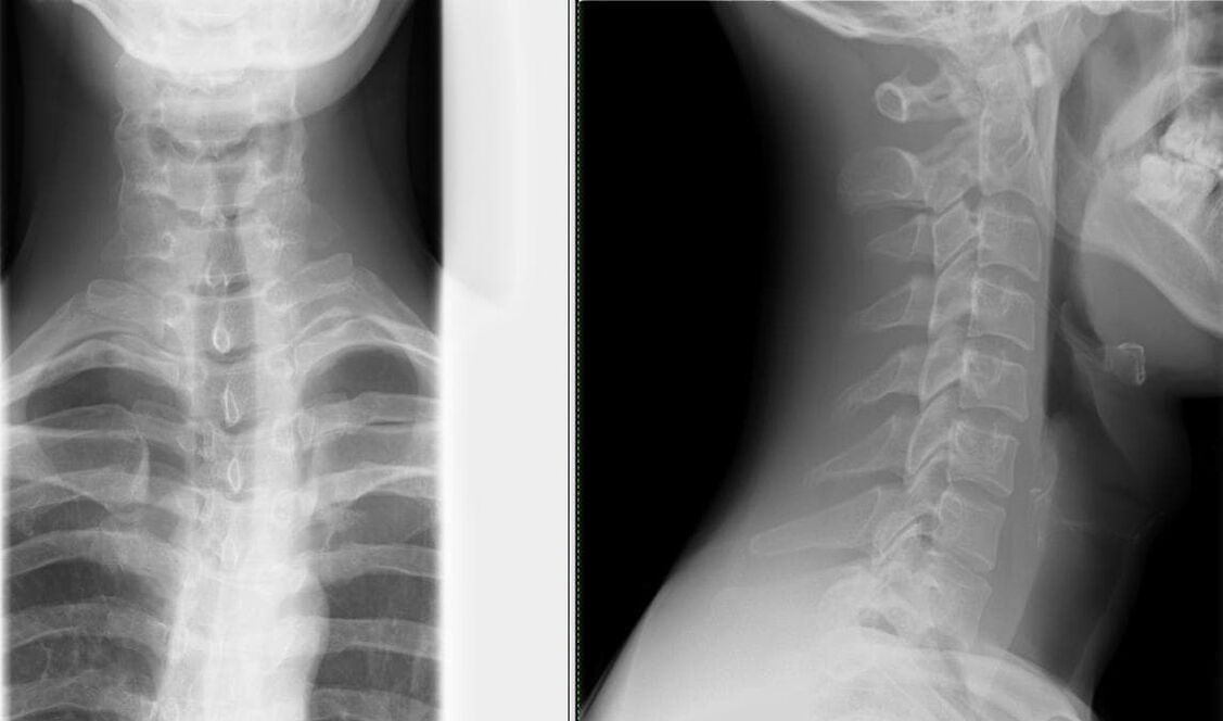 Radiografia coloanei vertebrale este o metodă simplă și eficientă de diagnosticare a osteocondrozei