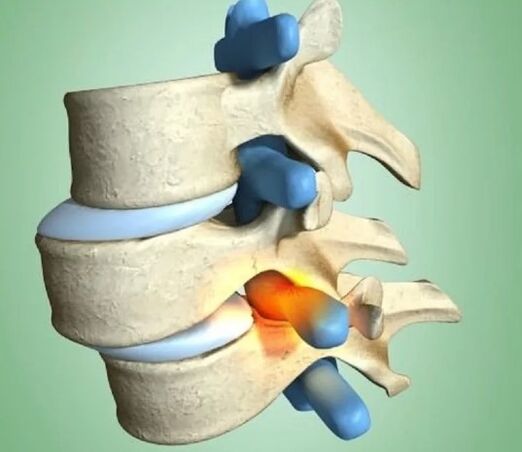 Poziția instabilă a vertebrelor